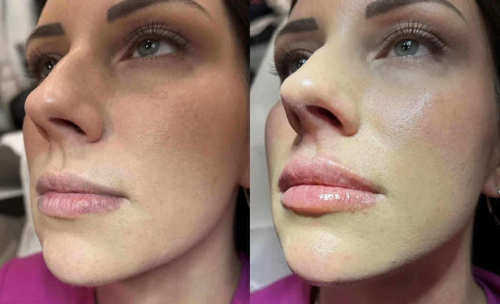 Before and after photo by Jessica Redden of Fort Worth Medspa in Fort Worth, TX