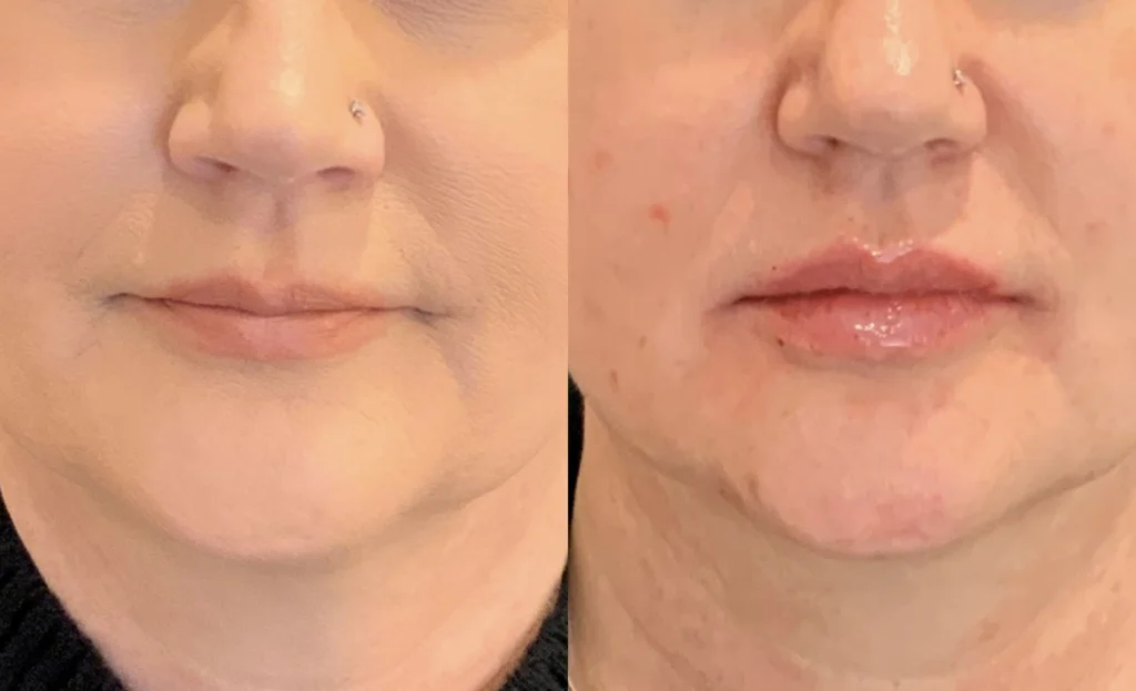 before and after photo by fort worth medspa in fort worth tx