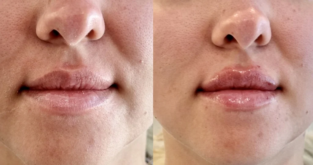 Before and after photo by Tamara Clark of Fort Worth Medspa in Fort Worth, TX