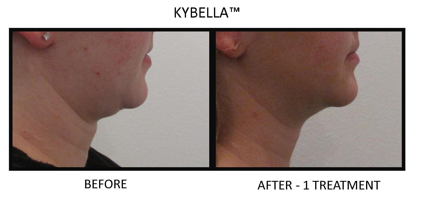 Kybella before and after photo by Fort Worth Medspa in Fort Worth, TX