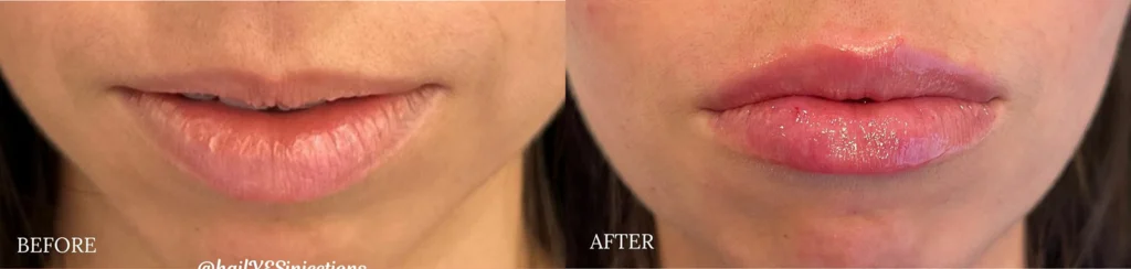 Juvederm Ultra before and after photo by Fort Worth Medspa in Fort Worth, TX
