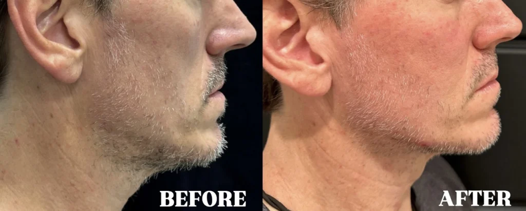 Juvéderm Voluma before and after photo by Fort Worth Medspa in Fort Worth, TX