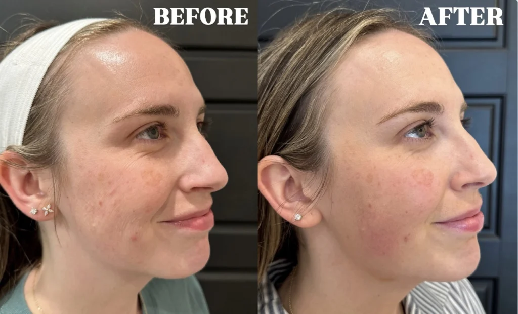 Juvederm Ultra before and after photo by Fort Worth Medspa in Fort Worth, TX
