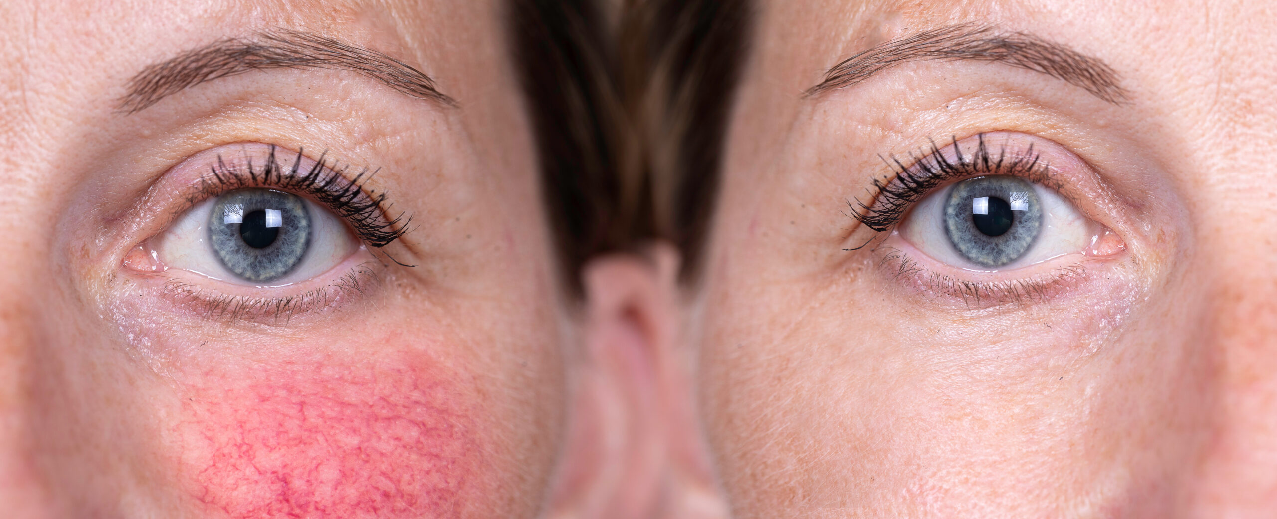 A mature caucasian woman in her early s shows the before and after results of successful treatment for rosacea, superficial blood vessels and rosy cheeks have diminished. A mature caucasian woman in her early s shows the before and after results of successful treatment for rosacea, superficial blood vessels and rosy cheeks have diminished.